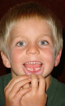 Joel's Lost Tooth